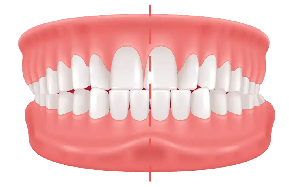 Illustration of a set of human teeth in a closed mouth, seen from the front. A vertical red line divides the image symmetrically through the center of the teeth and gums, indicating alignment. Teeth are white and the gums are pink.