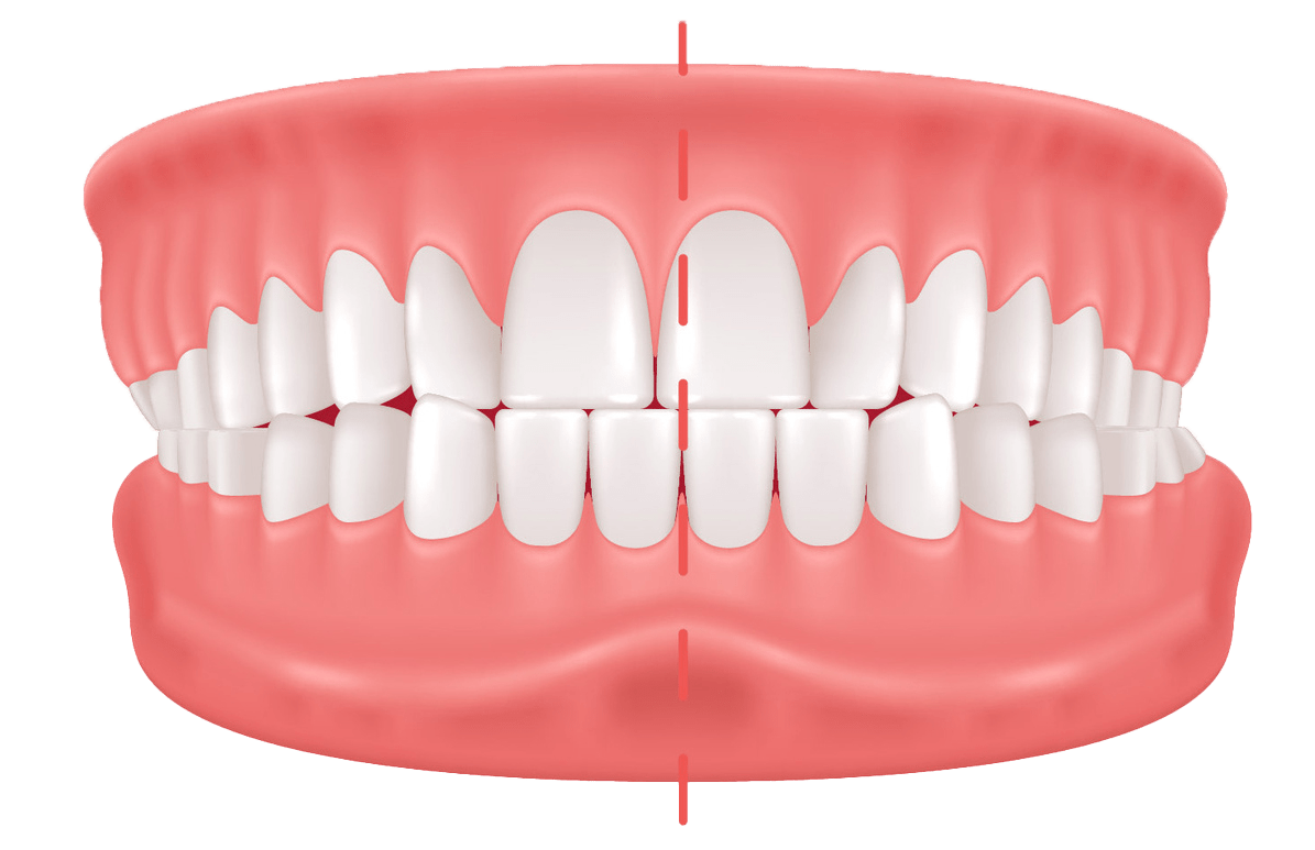 Illustration of a set of human teeth in a closed mouth, seen from the front. A vertical red line divides the image symmetrically through the center of the teeth and gums, indicating alignment. Teeth are white and the gums are pink.