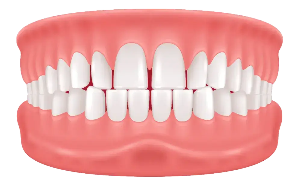 Illustration of a full set of adult human teeth and gums. The teeth are shown from the front, with both the upper and lower rows visible, displaying healthy and symmetrical alignment within pink gums.