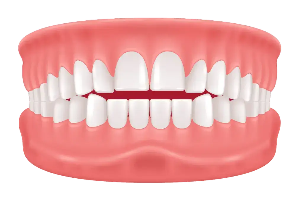 Illustration of a teeth model showing a full set of upper and lower teeth aligned in gums. The teeth are shown from the front, with the upper and lower rows slightly apart, highlighting the white teeth and pink gums.