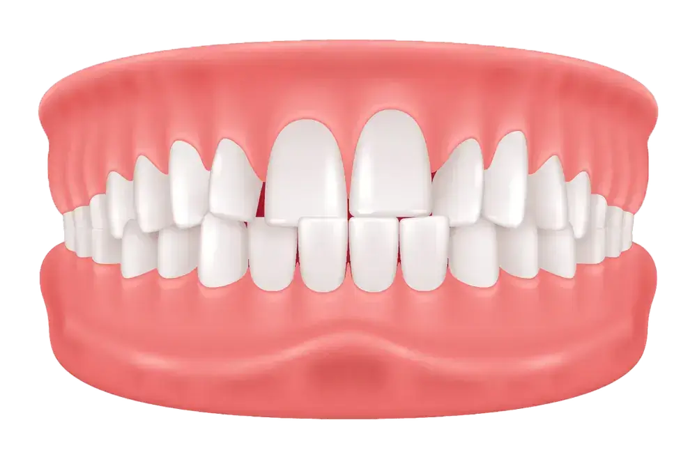 Illustration of a full set of human teeth in an open mouth, showing the upper and lower gums. The teeth appear evenly aligned and healthy against the pink gums.