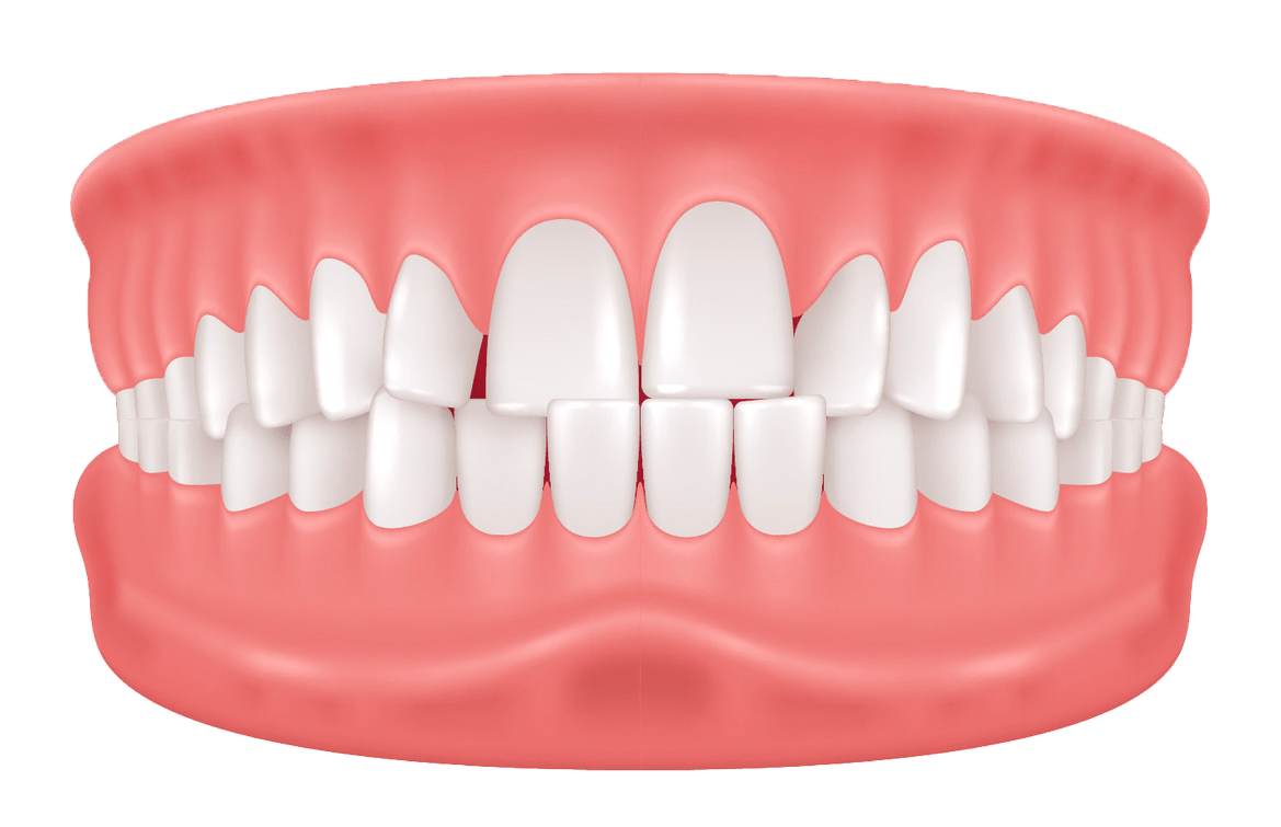 Illustration of a full set of human teeth in an open mouth, showing the upper and lower gums. The teeth appear evenly aligned and healthy against the pink gums.