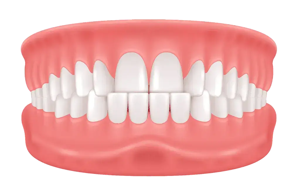 Illustration of a set of human teeth in a closed mouth position, showing upper and lower teeth. The gums are pink, and both rows of teeth are white and aligned. The image is isolated on a white background.