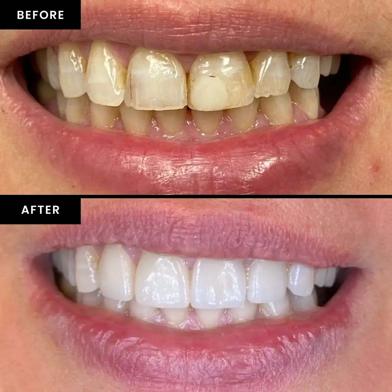 A close-up of a persons teeth showing a before and after comparison. The top image shows discolored and chipped teeth, while the bottom image shows straight, white teeth.