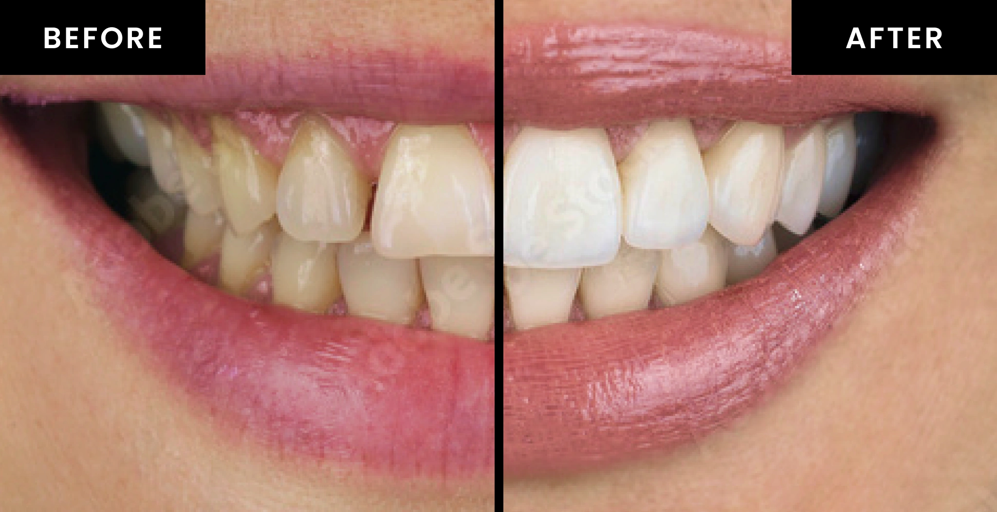 Split image showing two sets of teeth. The left side labeled Before shows slightly misaligned and yellower teeth. The right side labeled After shows straight, whiter teeth. Both images display a close-up of a smiling mouth.