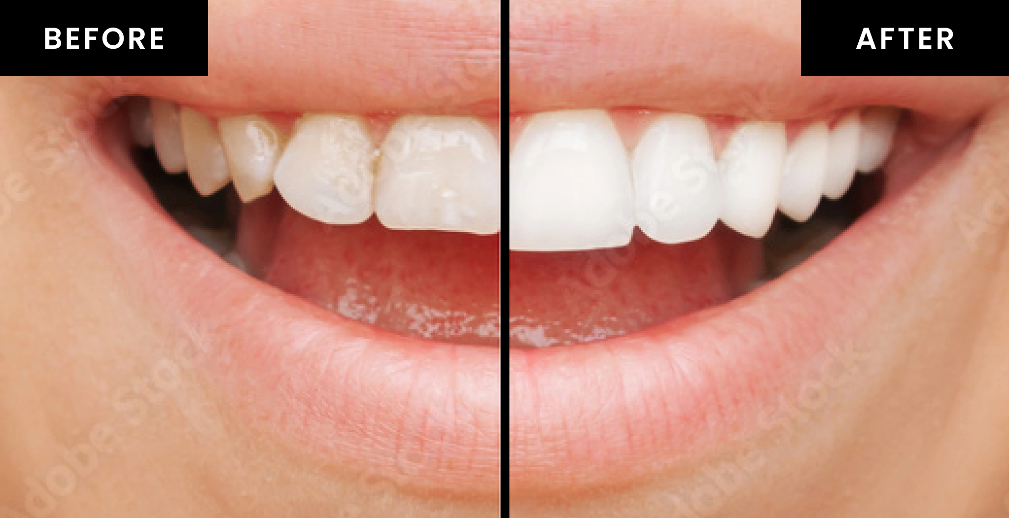 Split image of a persons smile, showing a dental transformation. The left side labeled Before shows teeth with discoloration, while the right side labeled After shows whitened, even teeth.