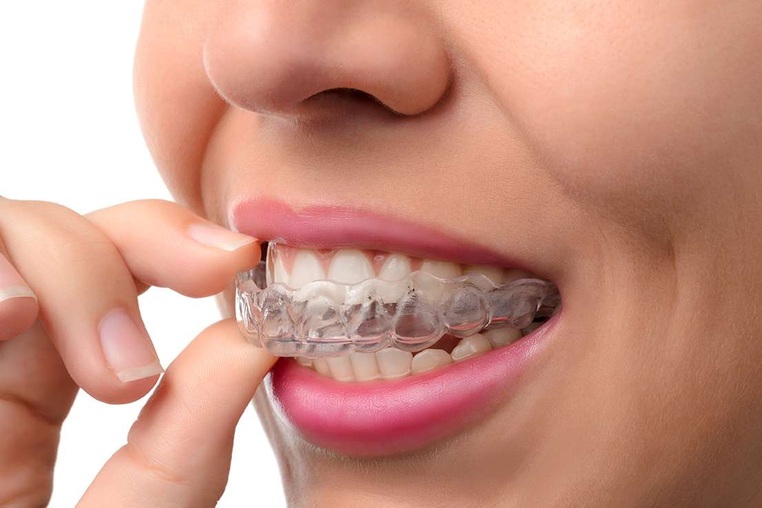 A person is placing a transparent dental aligner over their upper teeth. The close-up image shows the aligner being fitted with one hand, and part of the persons lips and teeth are visible.