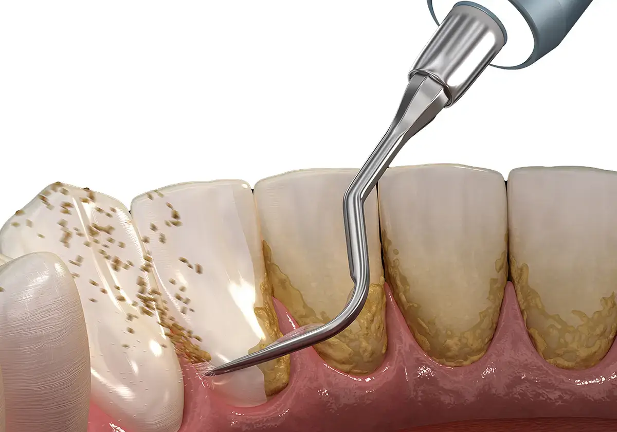 A dental illustration showing a scaler tool removing plaque and tartar from teeth. The gum line is visible, with a close-up view of the cleaning process.